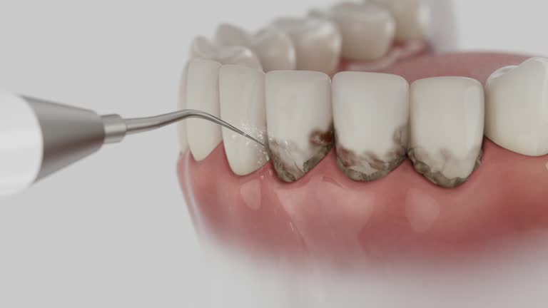Trusted Wisdom Tooth Removal service in College Park, MD - Dentist Open Now